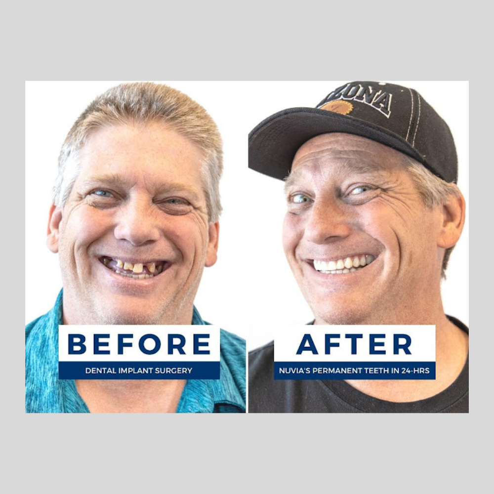 Before and after dental implant procedure
