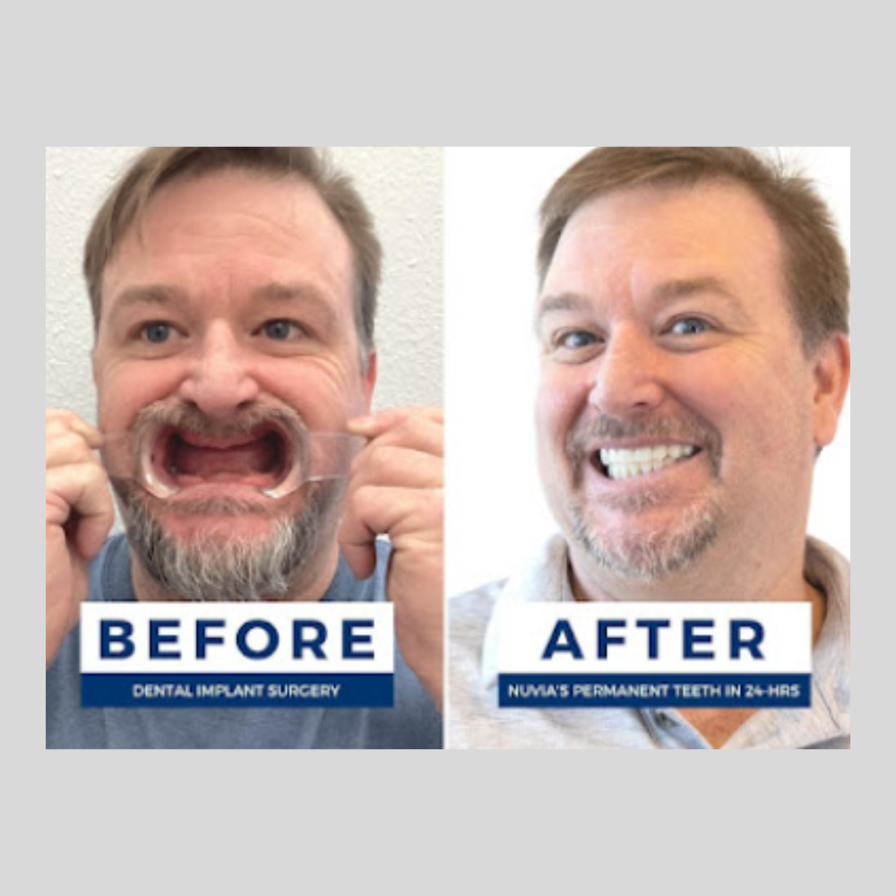 Before and after dental implants