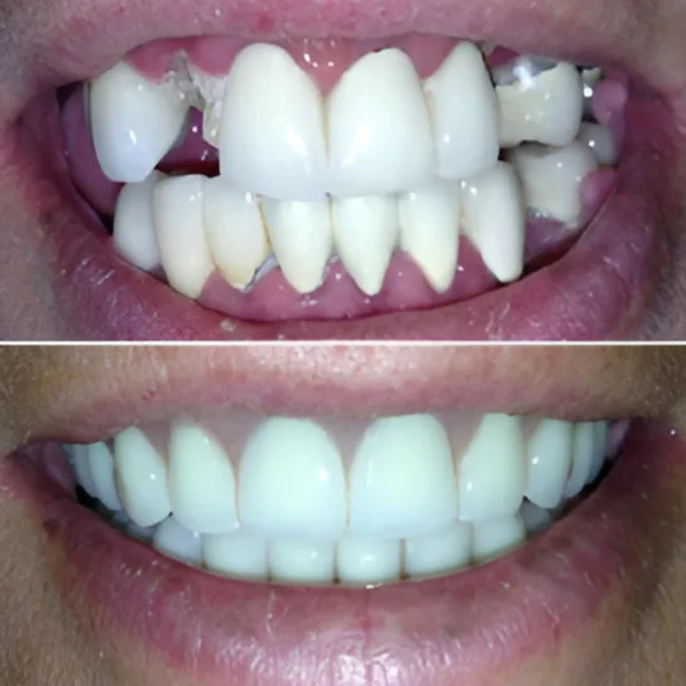Before and after dental implants